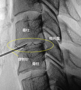 セルゲル法の治療 X線透視画像1