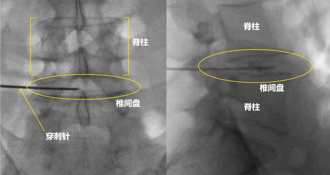 セルゲル法の治療 X線透視画像1