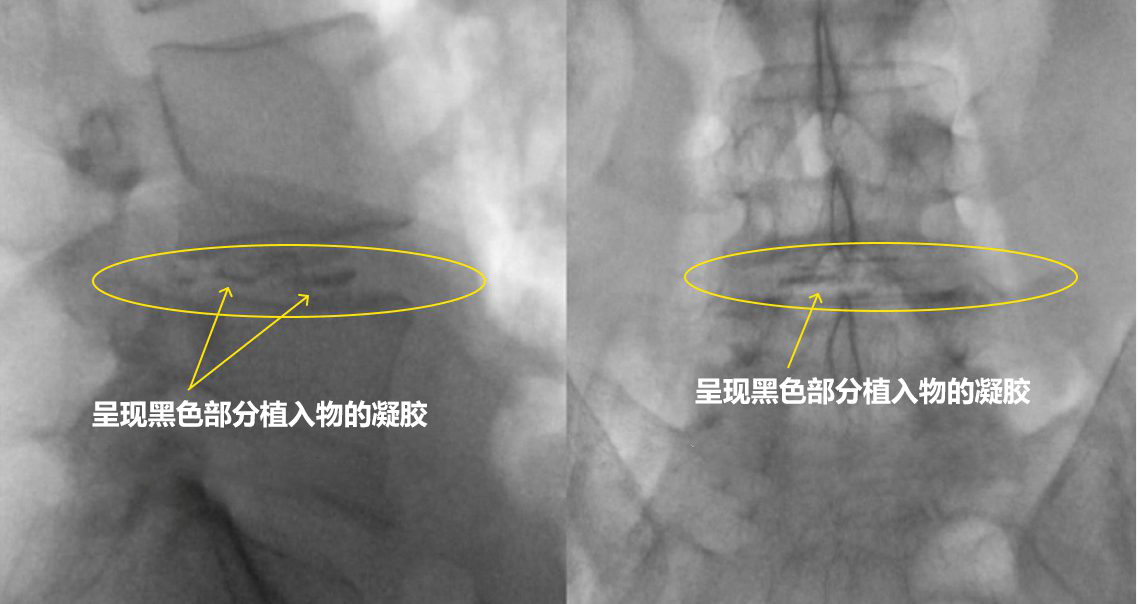 Cellgel法治疗X射线透视图像2