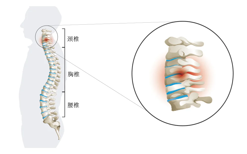 椎间盘退变的情况