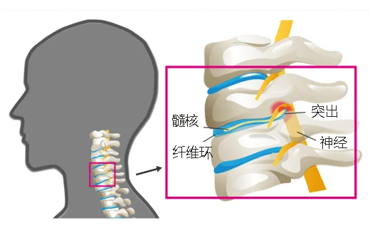 颈椎间盘突出症图解