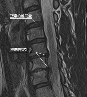 颈椎间盘突出的原因图解