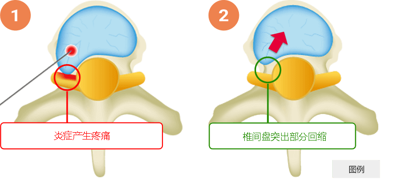 椎間板ヘルニア レーザー焼灼 イメージ