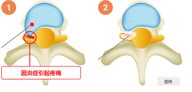 椎间盘突出症激光消融术图像