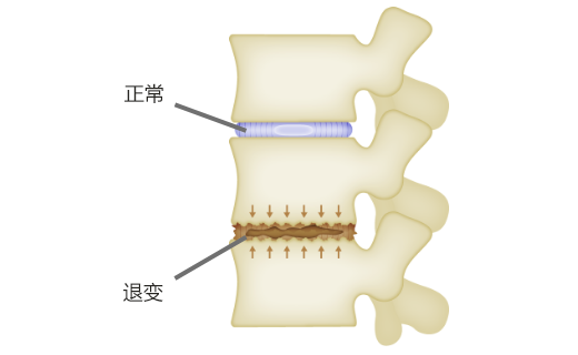 椎间盘退变的插图