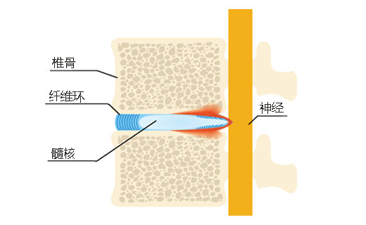 椎间盘突出的插图