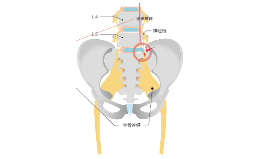 坐骨神经痛的插图