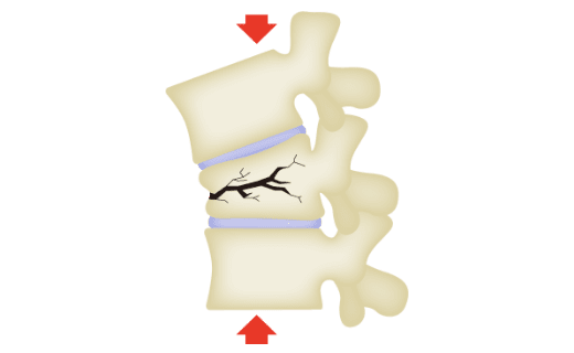 腰椎压缩性骨折图解