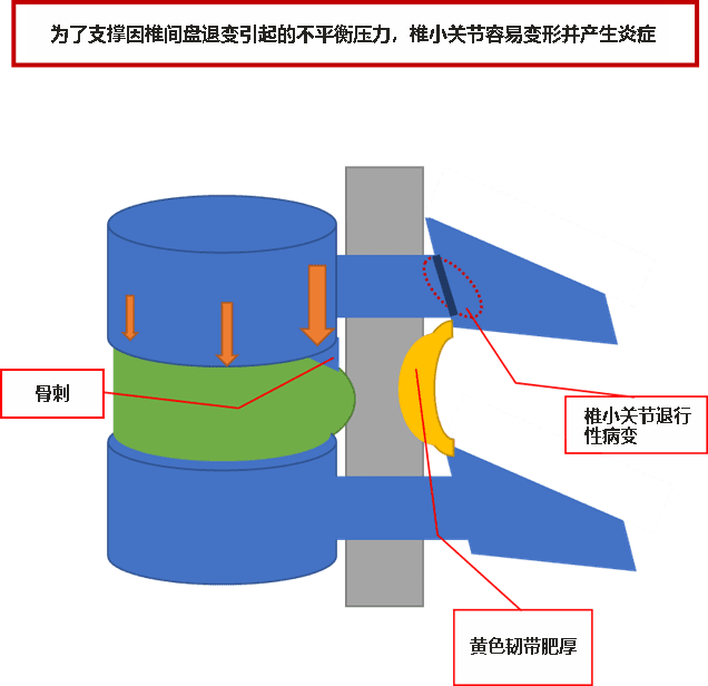 椎间盘退变和炎症