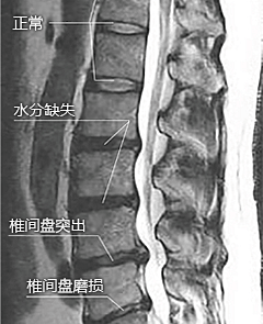 椎间盘突出的原因图解