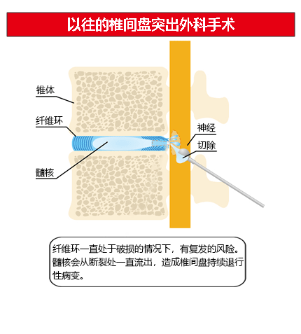 椎间盘突出疼痛的原因图解