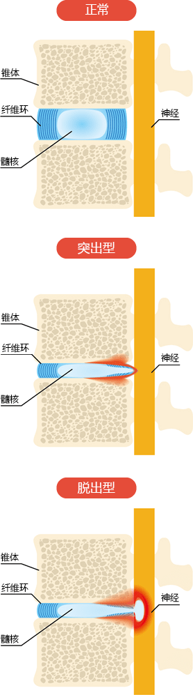 椎间盘突出的症状图