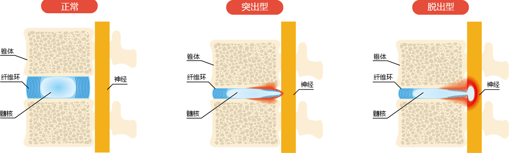 椎间盘突出的症状图