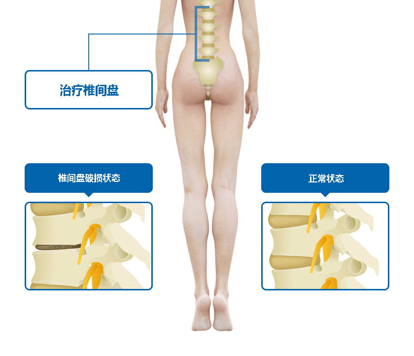 椎间盘治疗部位