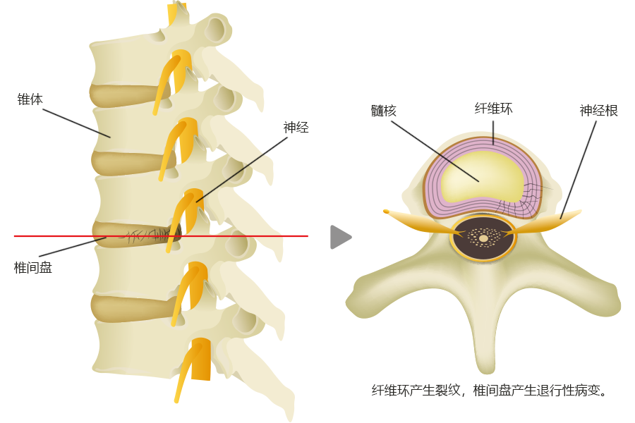 椎间盘退变的情况