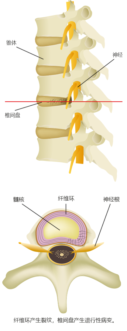 椎间盘退变的情况