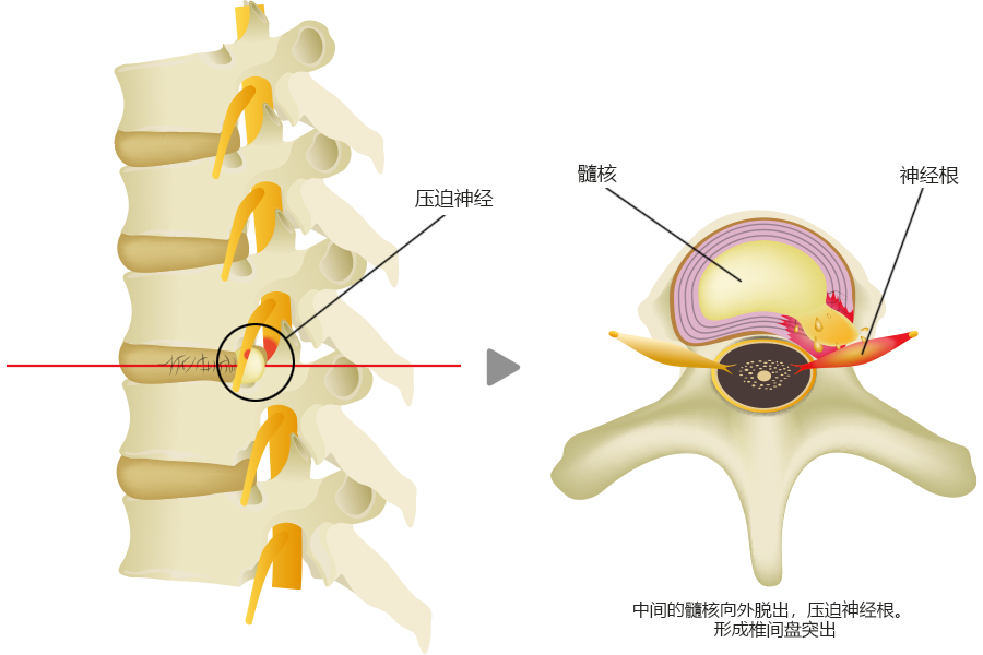 椎间盘退变的情况