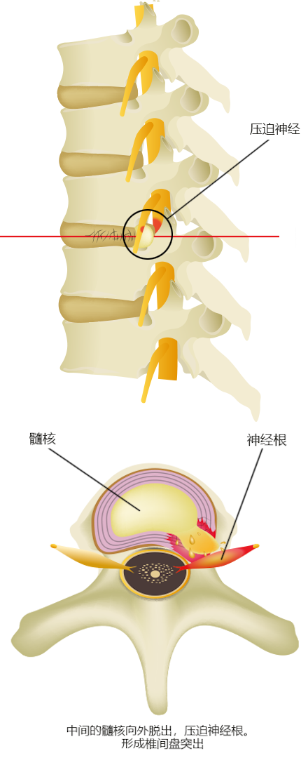 椎间盘退变的情况