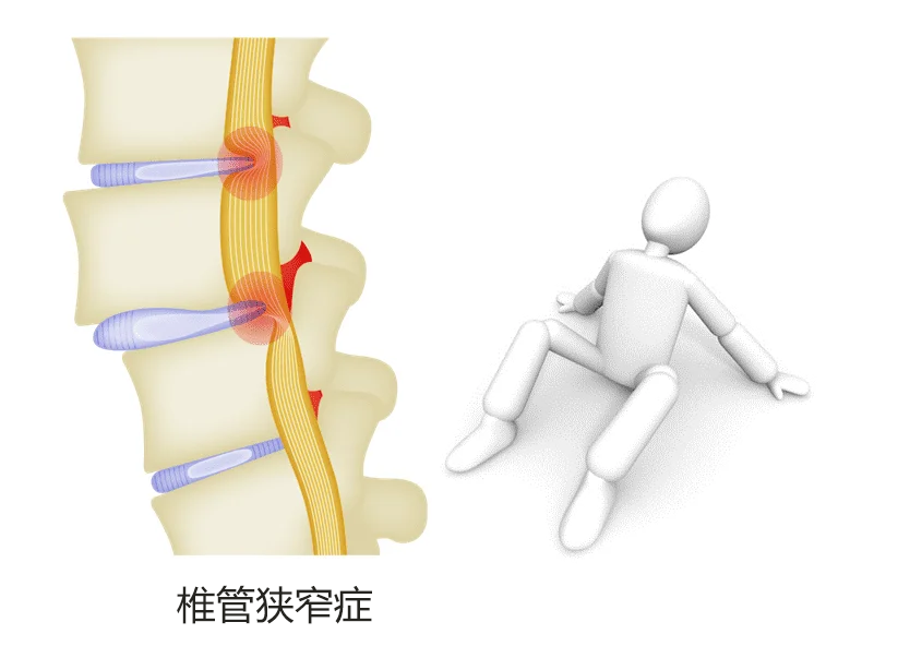 间歇性跛行的图片