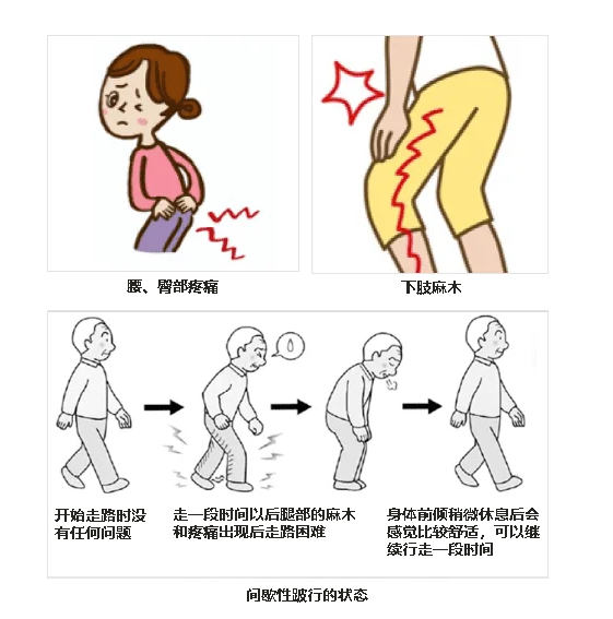 退行性腰椎病