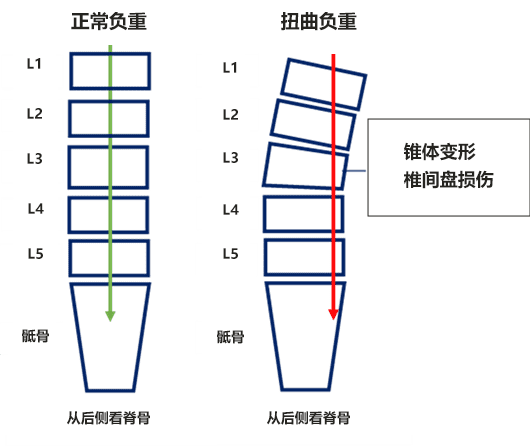 正常脊柱和扭曲脊柱