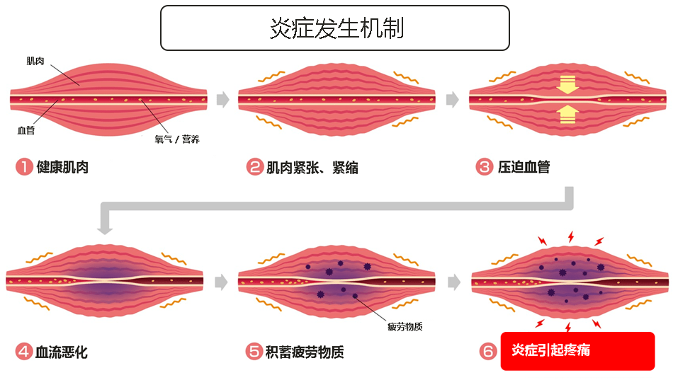 肌筋膜腰痛原因图