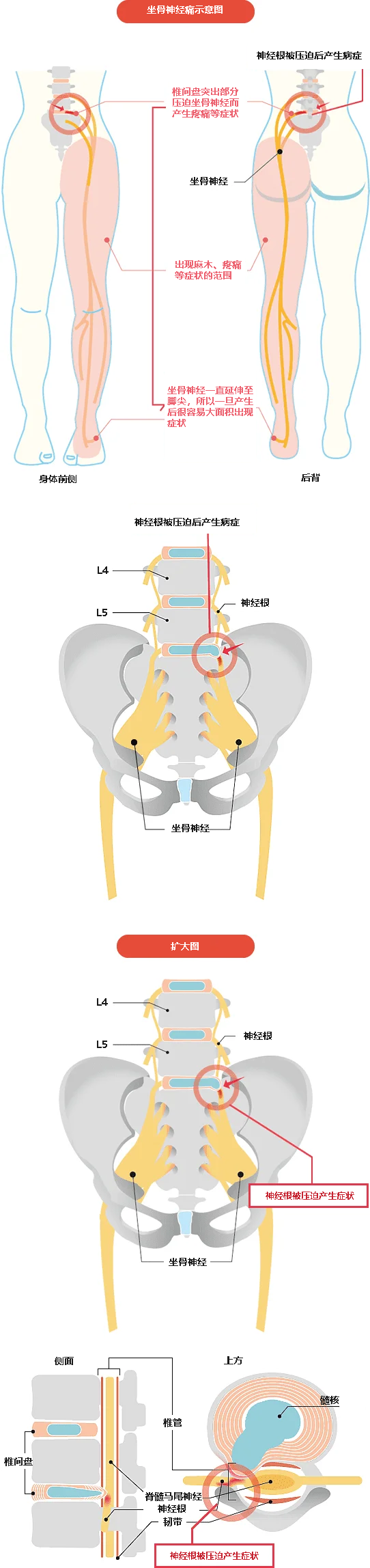 坐骨神经图片