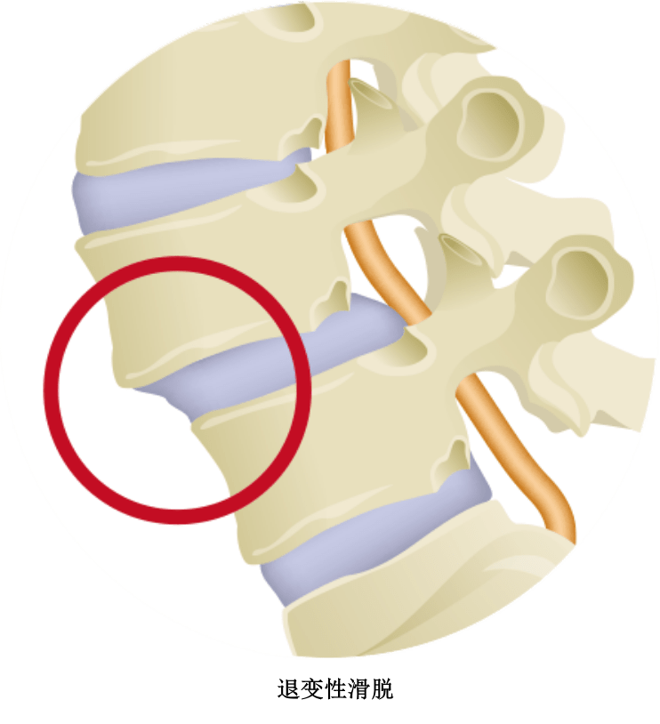 退行性脊椎滑脱