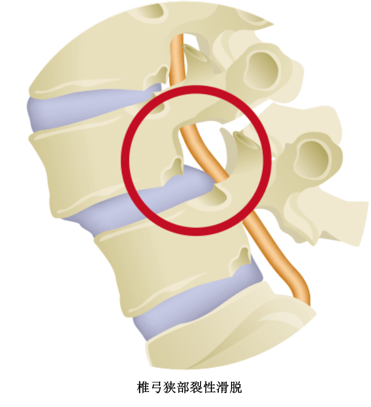 脊椎滑脱