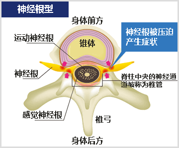 神经根型图像