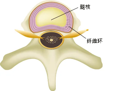椎間板ヘルニア イメージ