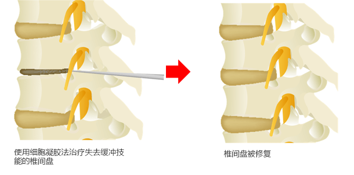 Cellgel法的治疗图像