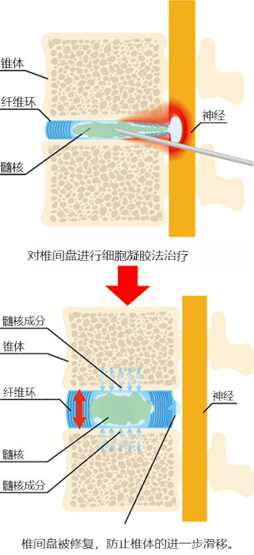 Cellgel法的治疗图像