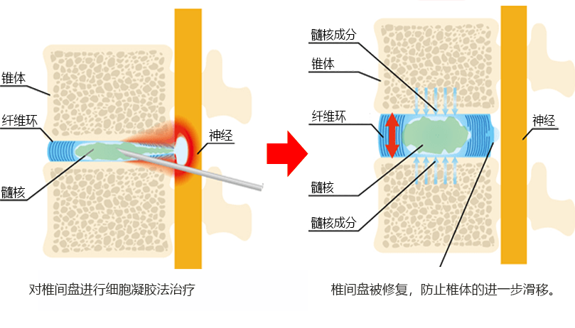 Cellgel法的治疗图像