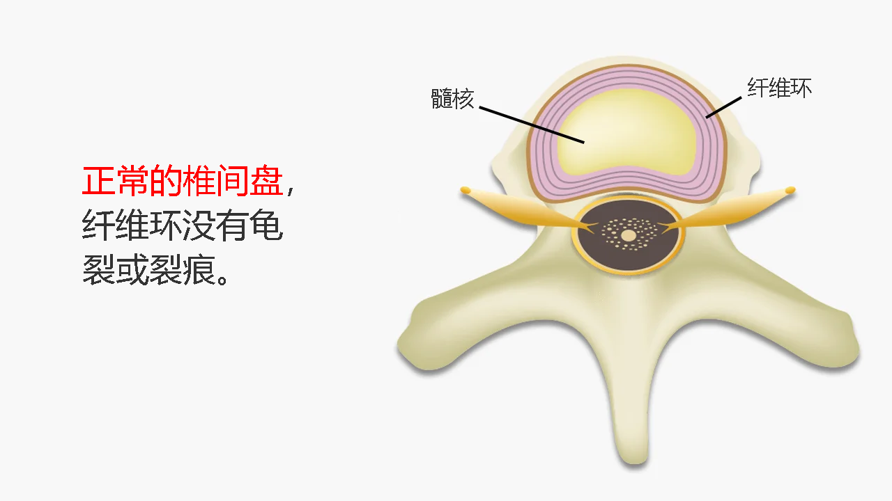 正常な椎間板では、繊維輪に亀裂やひび割れはない