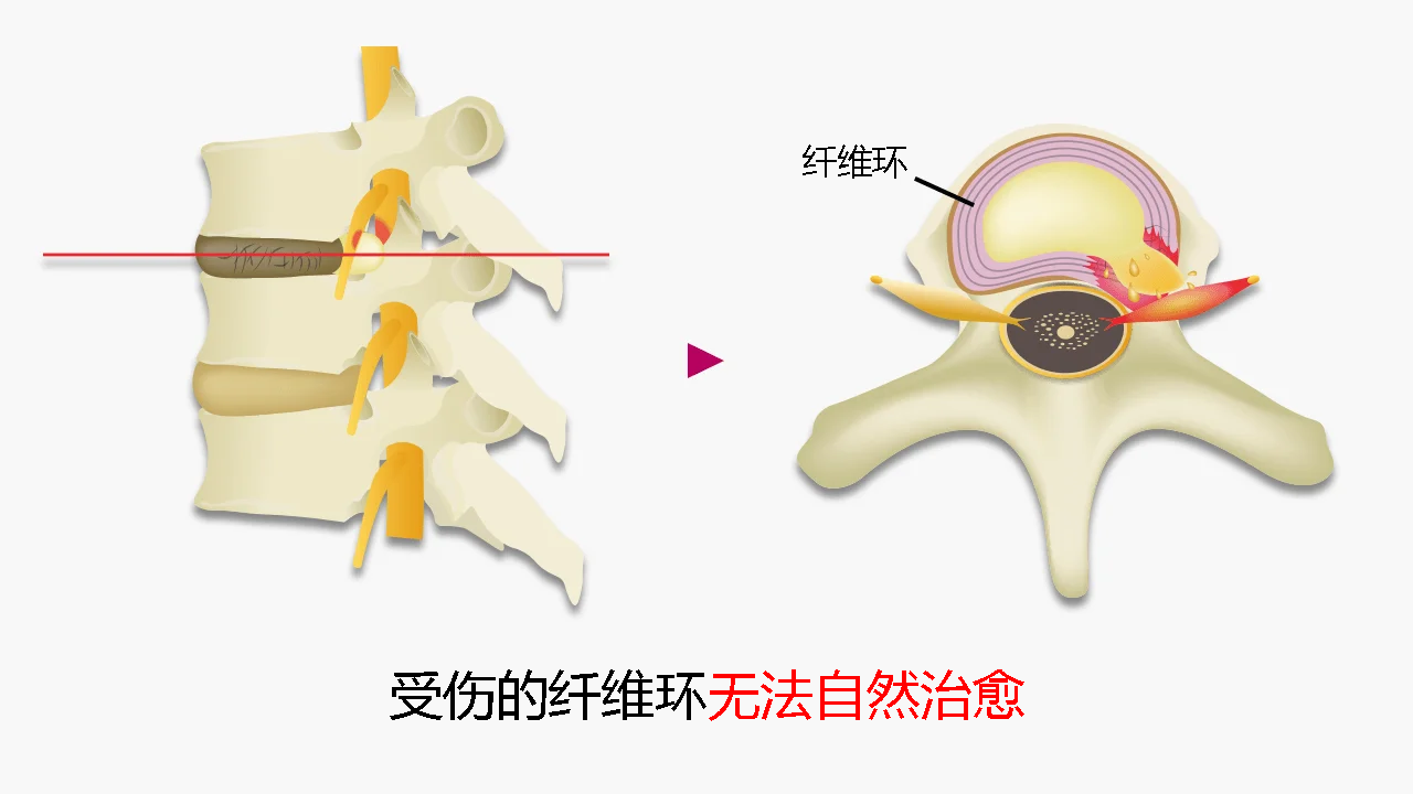 受损的纤维环不会自行愈合