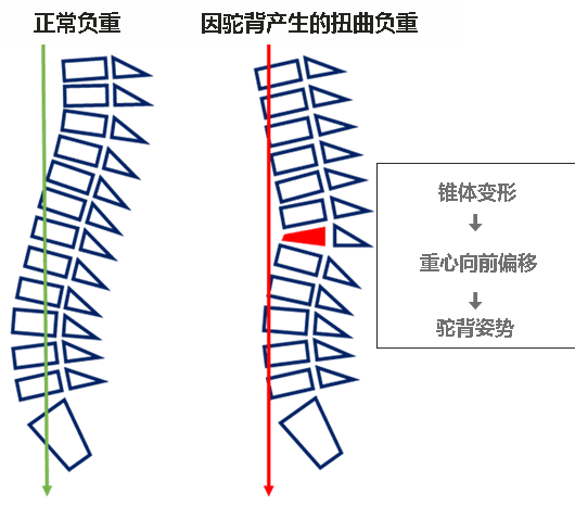 正常和弯曲的脊柱